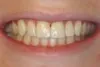 Periodontal Disease Dentist 