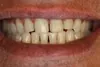 Porcelain Veneers Dentist 